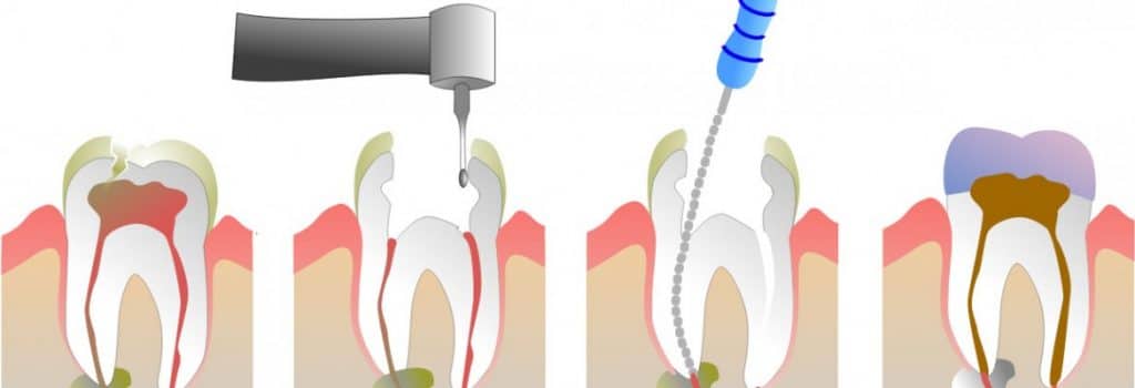 ENDODONTIE Cuvantul endodontie provine prin alaturarea a 2 cuvinte grecesti : endon-- in interior si odontos -- dinte.