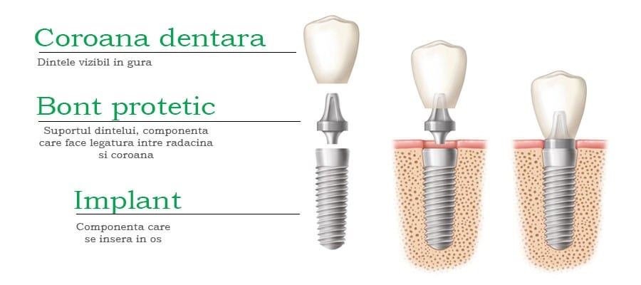 implanturi dentrare