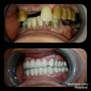 Reabilitare orala complexa