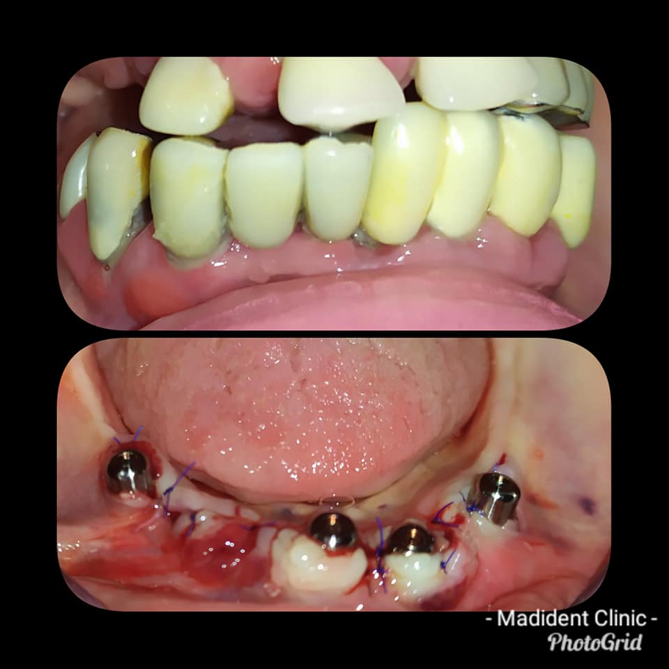 Implant dentar fara durere alba iulia