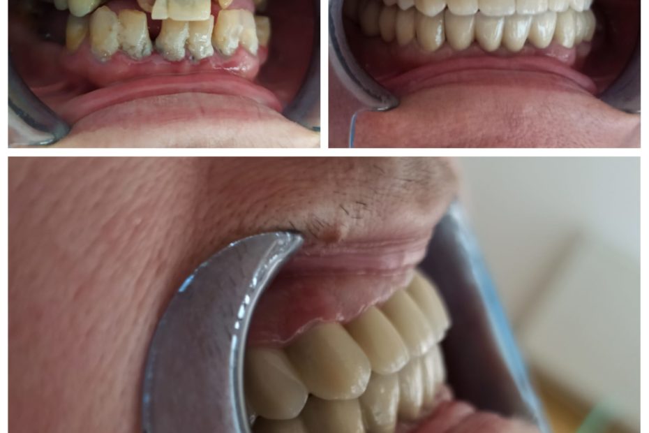 Reabilitare orală totală ceramică.