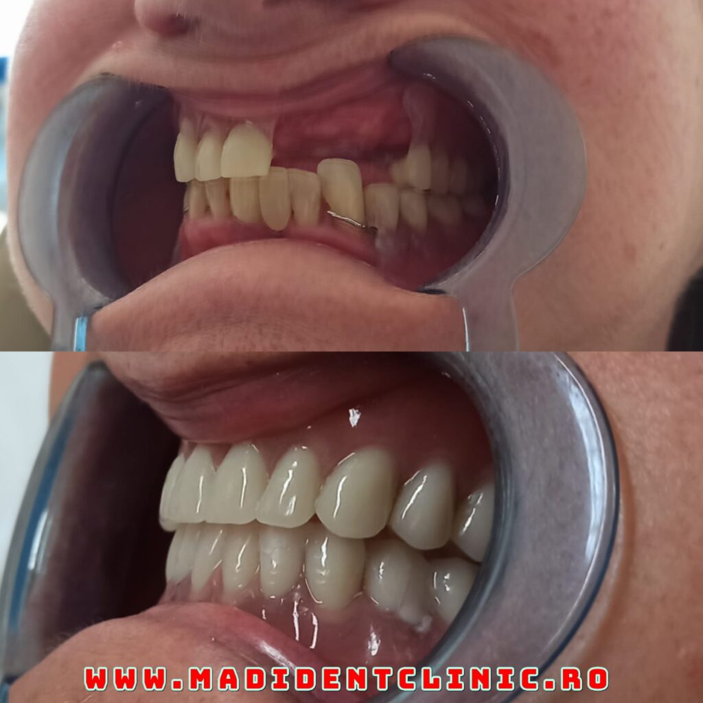 provizoria în implantologia orală