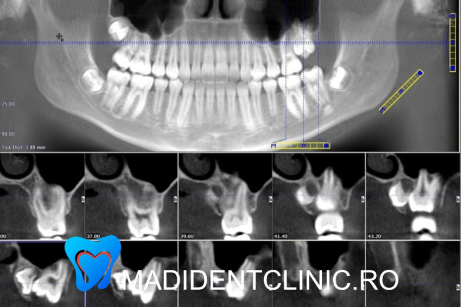 CT dentar: Rol și beneficii în implanturile dentare