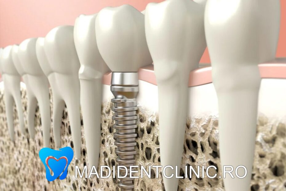 Implant dentar - Beneficii, riscuri și indicații pentru succes.
