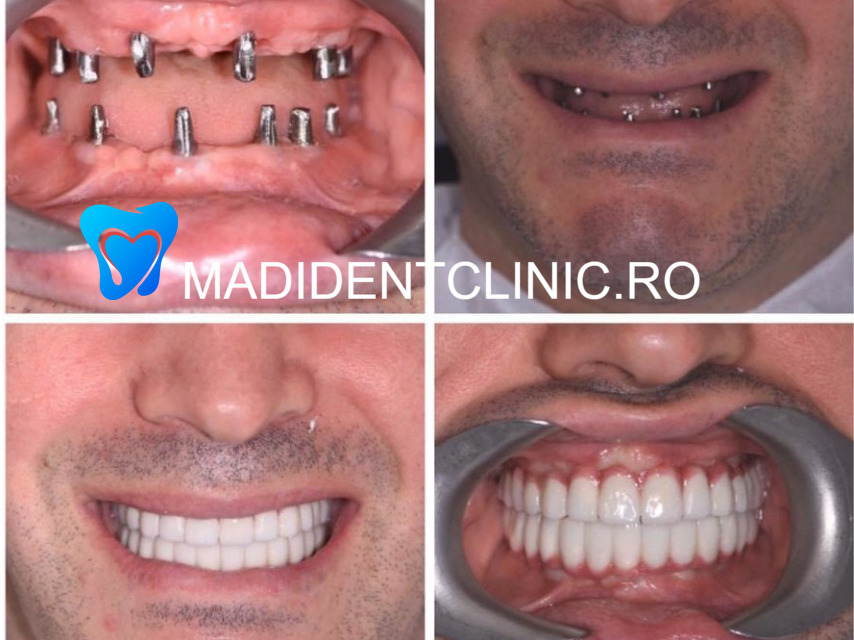 Implant dentar soluție de calitate pentru înlocuirea dinților