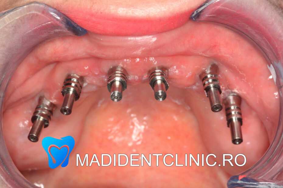 Recuperare post-operatorie implant dentar: semne și indicații