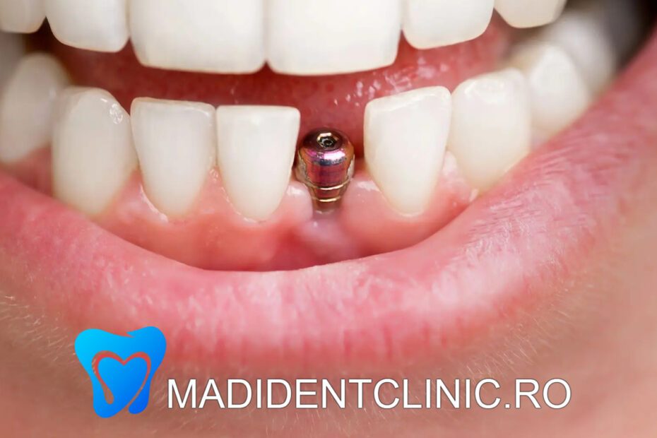 Implant dentar, componentele și etapele tratamentului